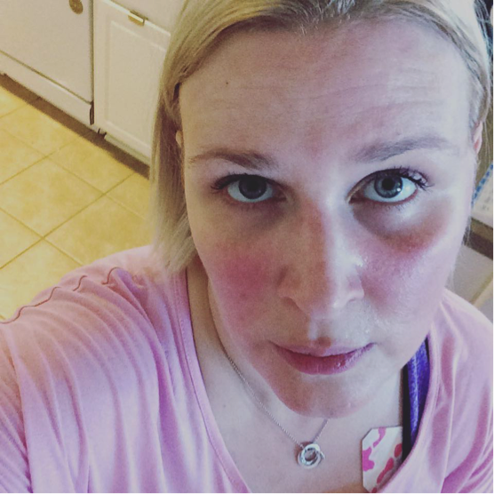 Rosacea - Why Is My Face Always Red And Broken Out?